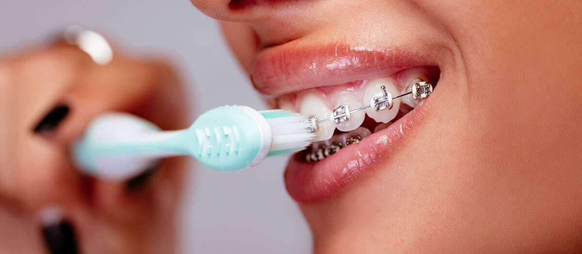 Care Following Orthodontics – Retainers